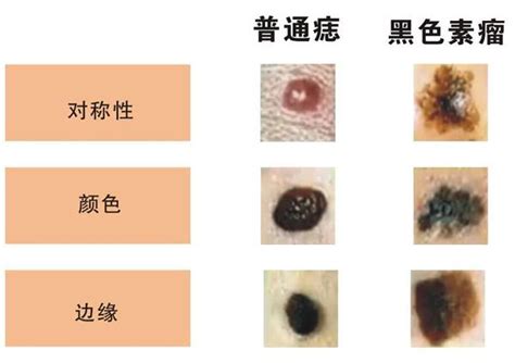 墨痣形成|墨形成與黑色素瘤關係